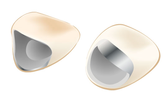 杉原歯科 メタルボンド