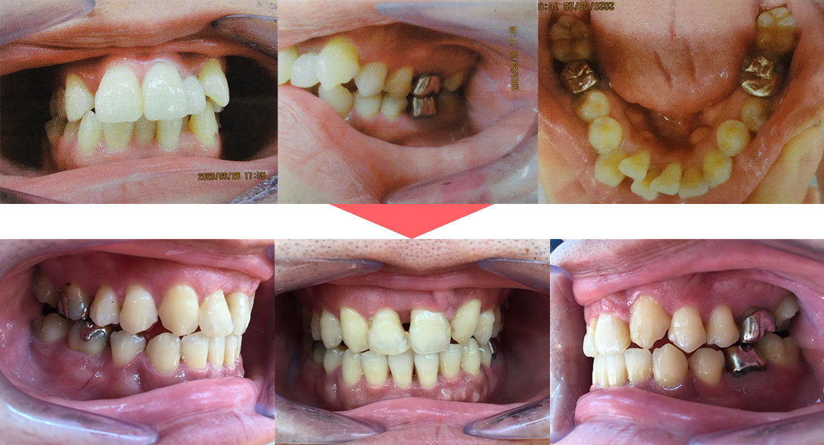 矯正歯科症例