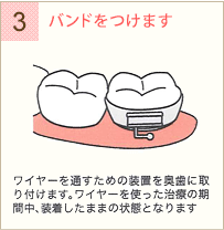 歯と顎を移動させるための方法