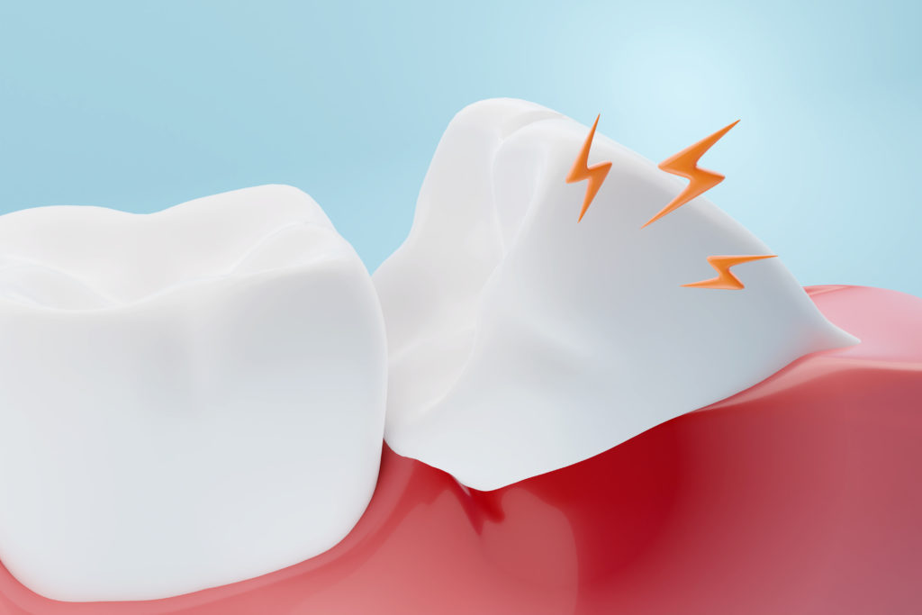 Dental impacted wisdom tooth infection. 3D rendering